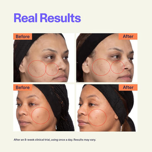 Curology Dark Spot Serum, Discoloration Fading Complex with Niacinamide, Facial Serum for Post Acne Marks and Sunspots, 1 Fl Oz