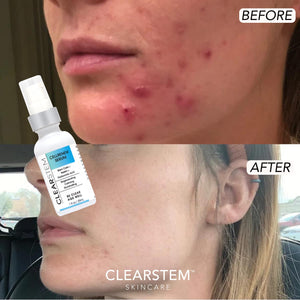 Clearstem - CELLRENEW - Collagen Stem Cell Serum - Acne + Youthful Skin Face Serum - Hyaluronic Acid, Reishi, Aloe Vera - Facial Skin Care Products - Vegan, Gluten Free, Cruelty Free - 1 Fl Oz / 29Ml
