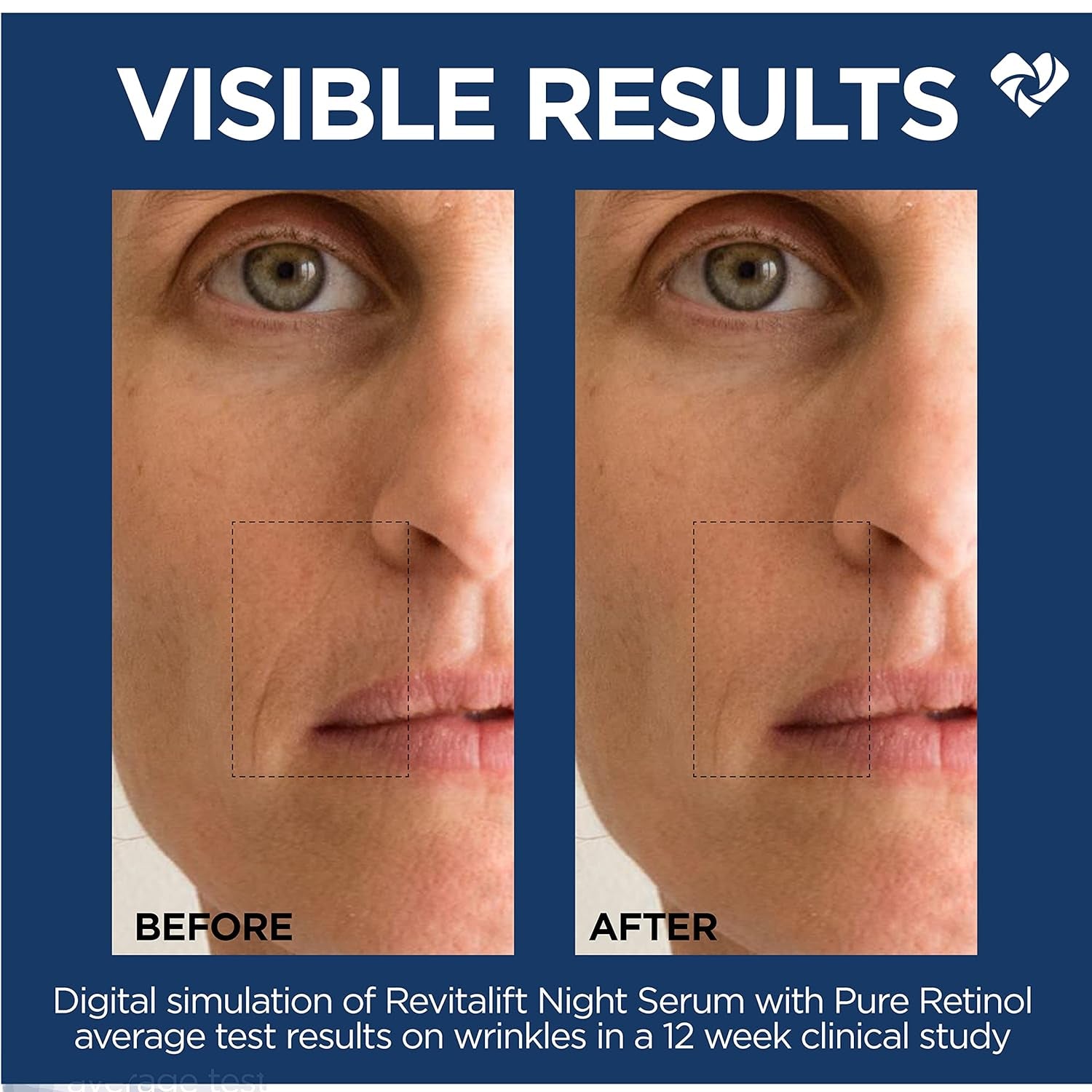 L'Oreal Paris Revitalift 0.3% Pure Retinol Night Serum, Reduce Deep Wrinkles, Fragrance Free 1 Oz + Moisturizer Sample