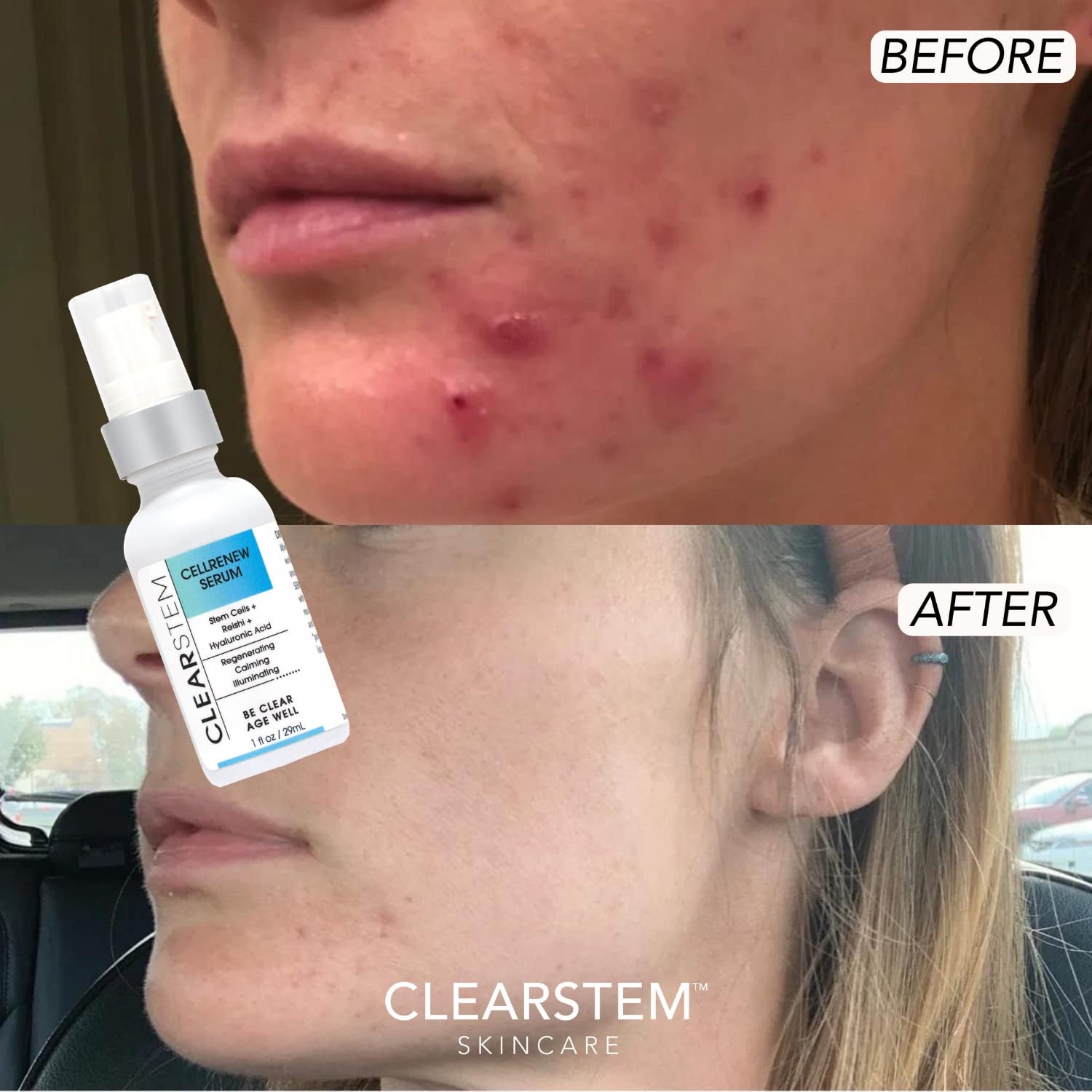 Clearstem - CELLRENEW - Collagen Stem Cell Serum - Acne + Youthful Skin Face Serum - Hyaluronic Acid, Reishi, Aloe Vera - Facial Skin Care Products - Vegan, Gluten Free, Cruelty Free - 1 Fl Oz / 29Ml