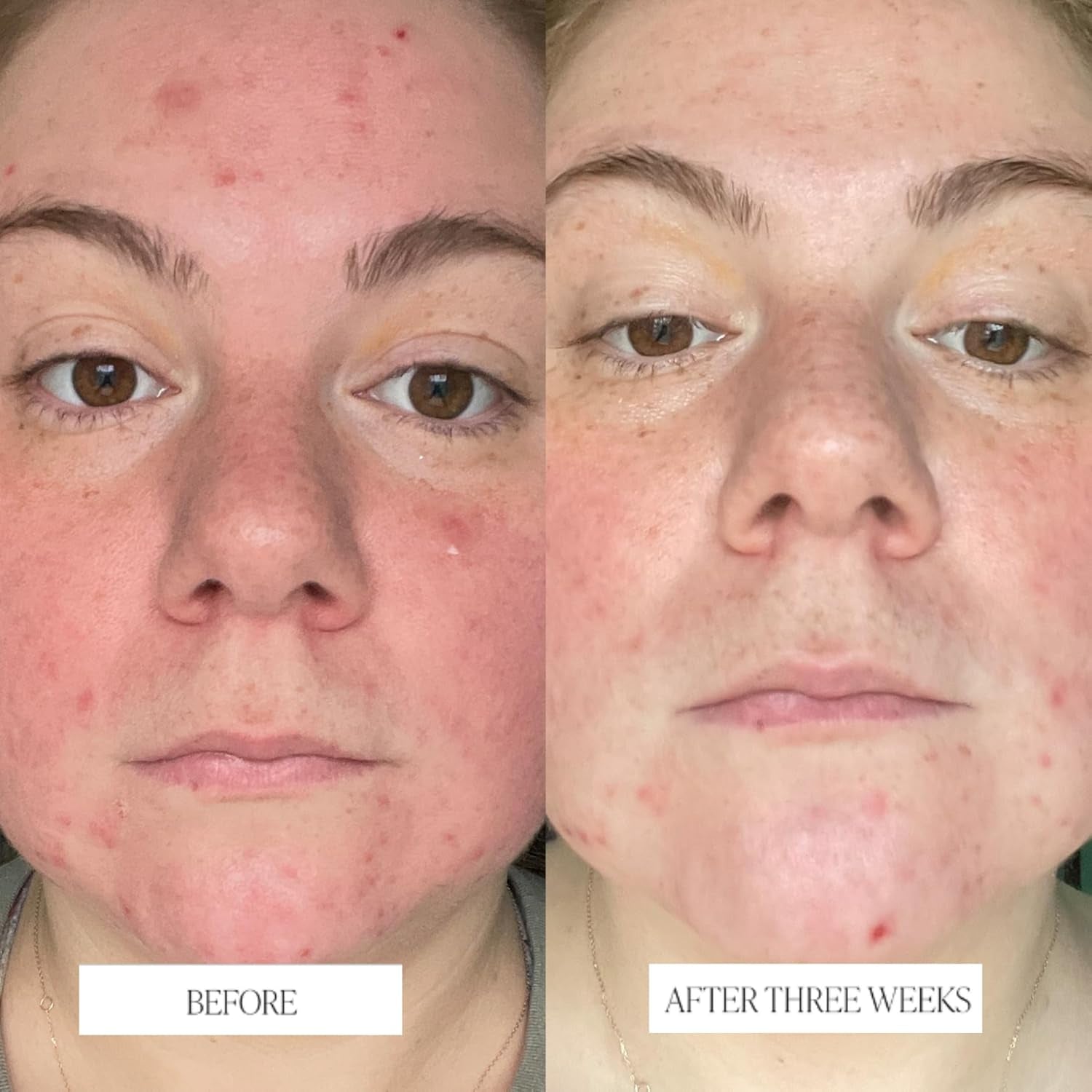 Byroe Exfoliating AHA Serum | Gentle Celery Serum for Resurfacing and Acne Prone Skin | Clarifying Pore Minimizer with Vitamin 12 Complex and LHA from Salicylic Acid | Vegan 30 ML