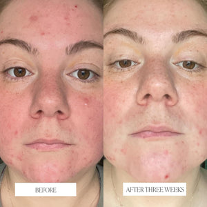 Byroe Exfoliating AHA Serum | Gentle Celery Serum for Resurfacing and Acne Prone Skin | Clarifying Pore Minimizer with Vitamin 12 Complex and LHA from Salicylic Acid | Vegan 30 ML